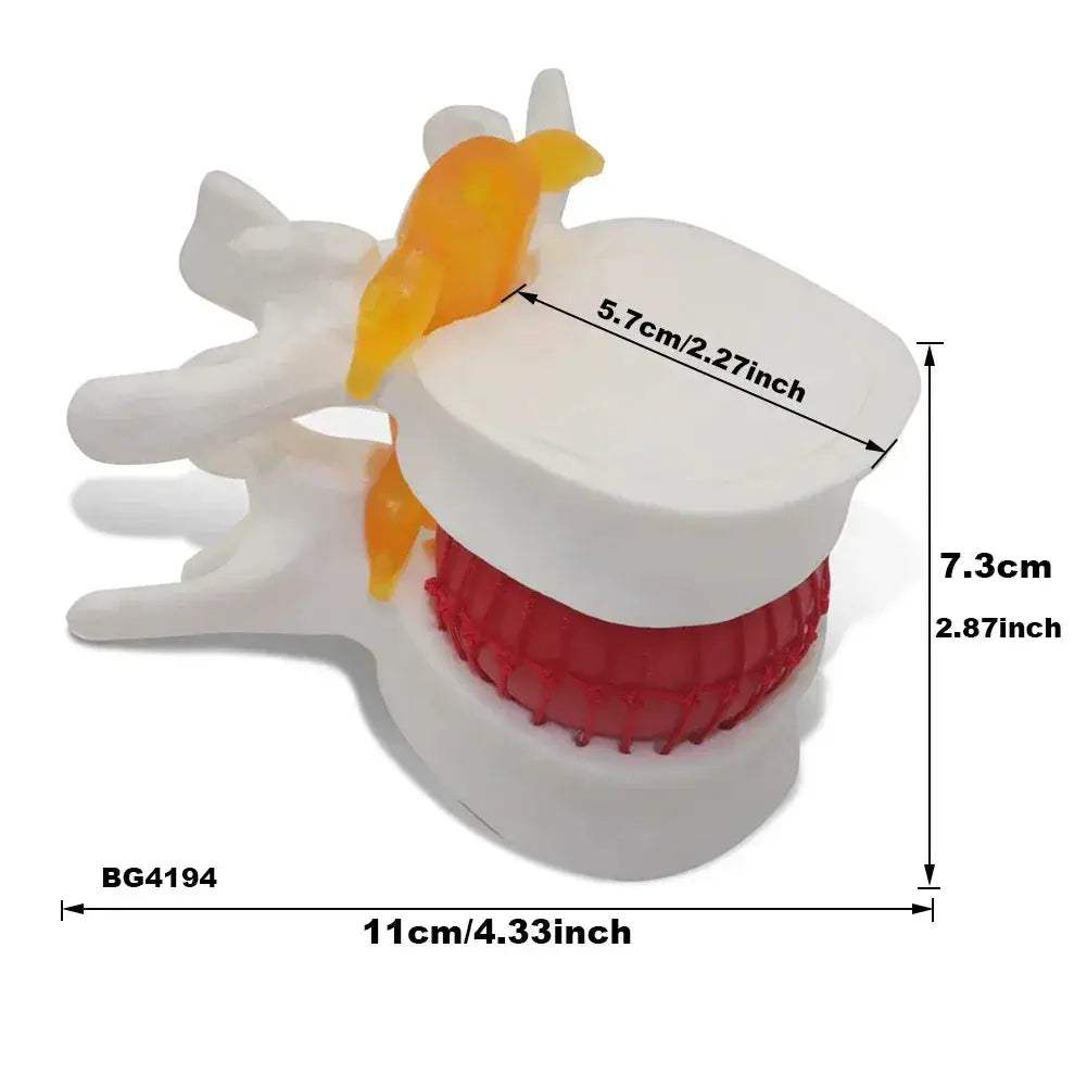 Intervertebral Disc Herniation Demonstration Model for Medical Teaching - ToylandEU
