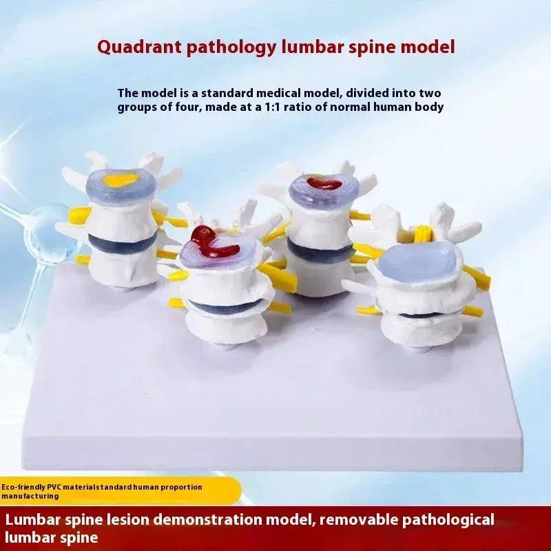  Lumbar Anatomy Model Disc Herniation Demonstration -  ToylandEU™
