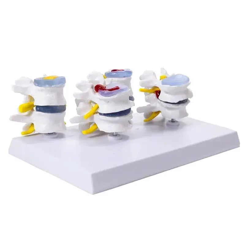 Lumbar Anatomy Model With Disc Herniation Demonstration For Medical Teaching - ToylandEU