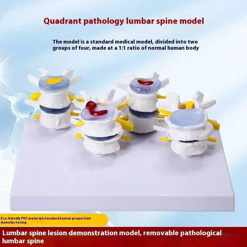 Lumbar Anatomy Model With Disc Herniation Demonstration For Medical Teaching - ToylandEU