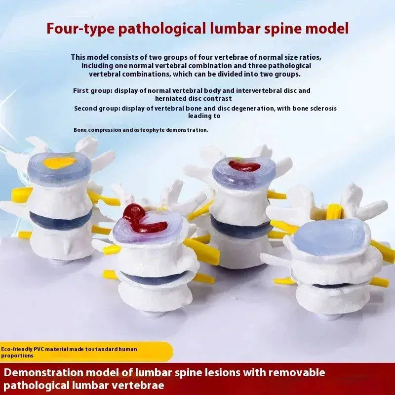 Lumbar Anatomy Model With Disc Herniation Demonstration For Medical Teaching - ToylandEU