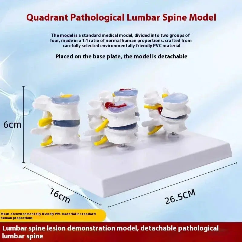 Lumbar Anatomy Model With Disc Herniation Demonstration For Medical Teaching - ToylandEU