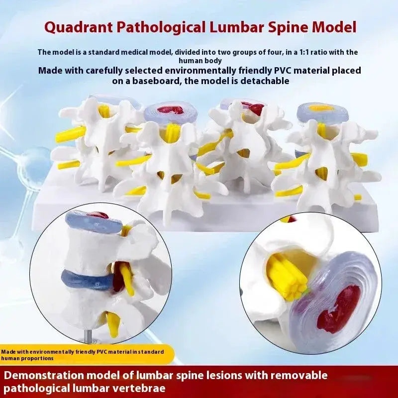 Lumbar Anatomy Model With Disc Herniation Demonstration For Medical Teaching - ToylandEU