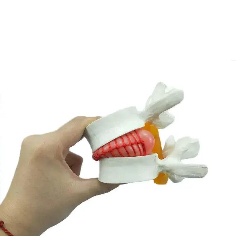  Lumbar Disc Herniation Model Accurate Medical Teaching -  ToylandEU™