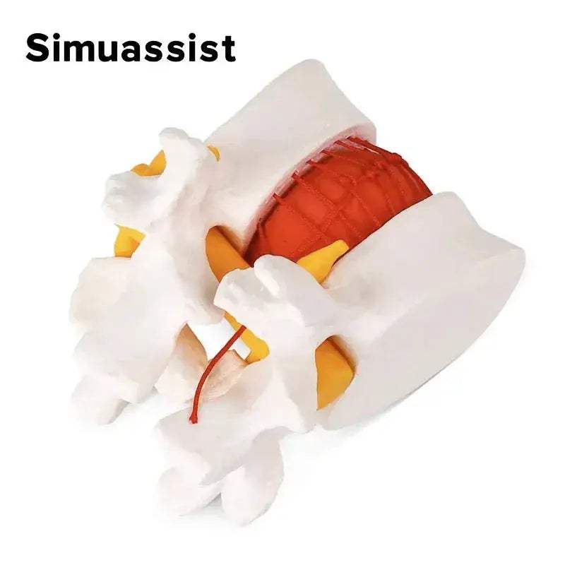 Lumbar Spine Disc Herniation Model For Realistic Medical Teaching - ToylandEU