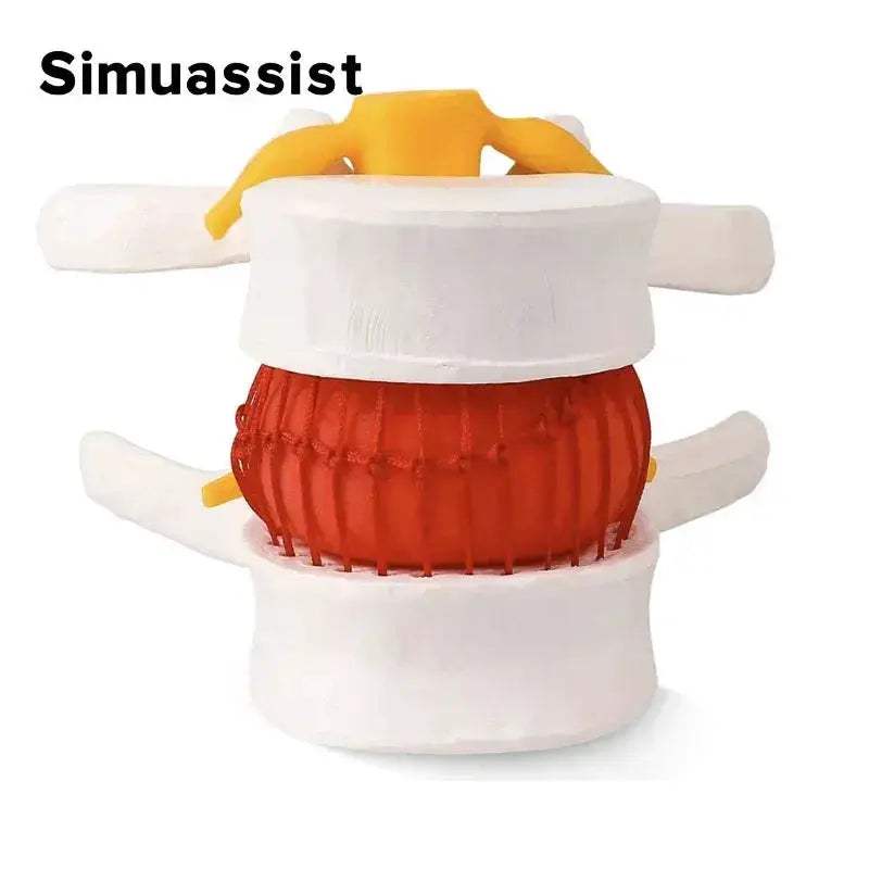 Lumbar Spine Disc Herniation Model For Realistic Medical Teaching - ToylandEU