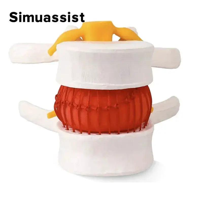  Lumbar Spine Disc Herniation Model Realistic Teaching -  ToylandEU™