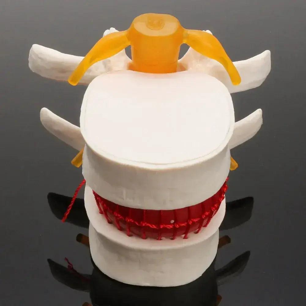  Lumbar Spine Disc Herniation Teaching Model For Training -  ToylandEU™