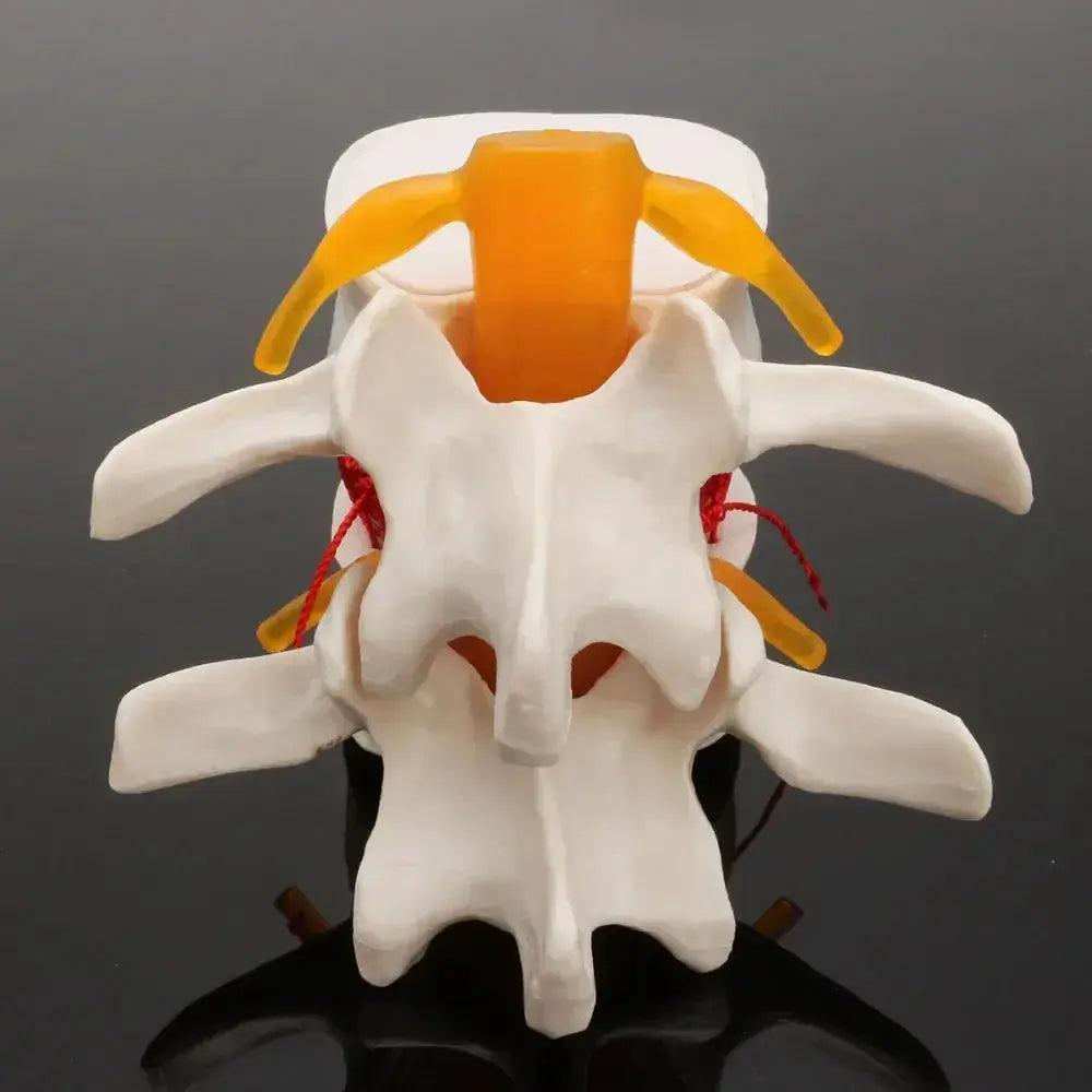  Lumbar Spine Disc Herniation Teaching Model For Training -  ToylandEU™