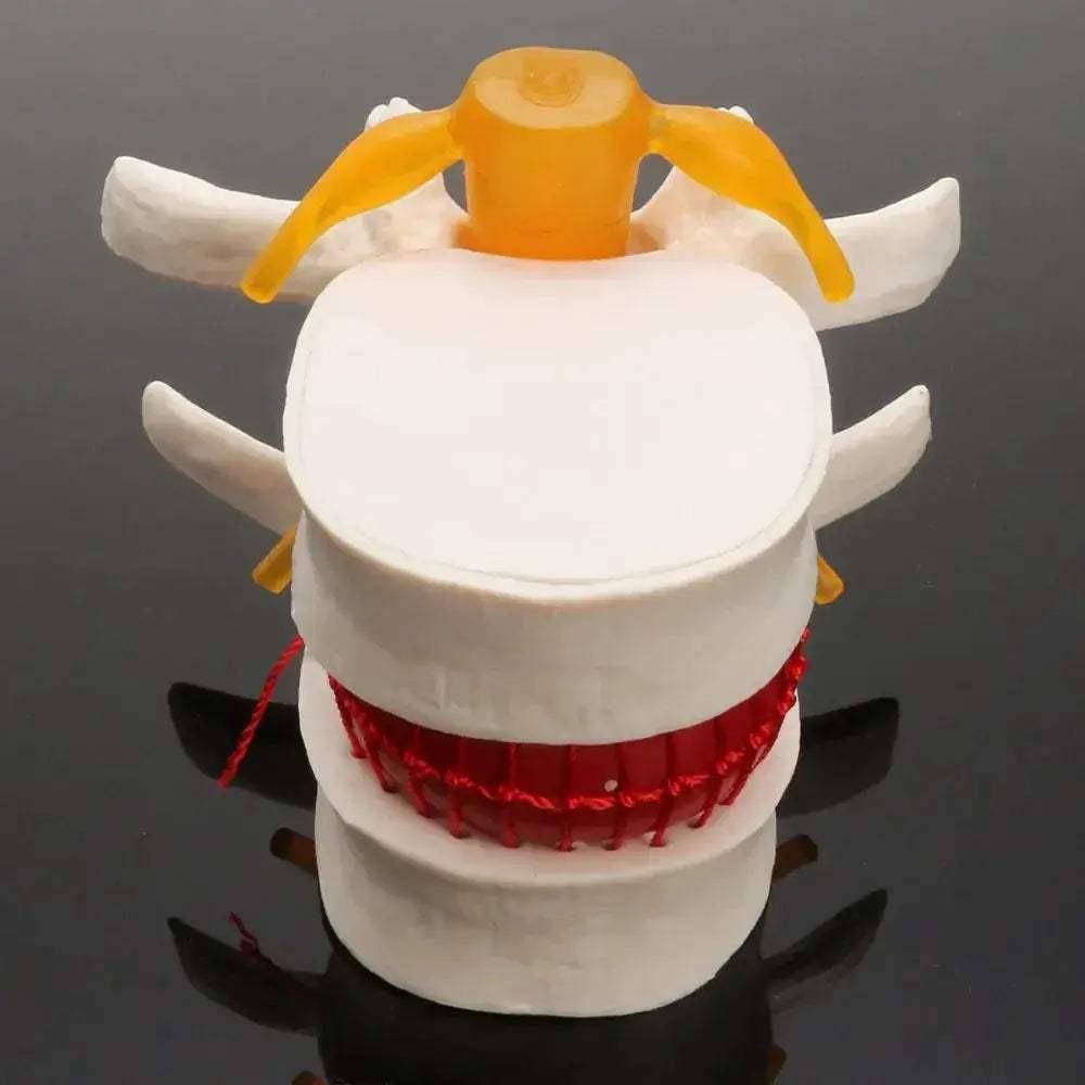 Lumbar Spine Disc Herniation Teaching Model for Medical Education - ToylandEU