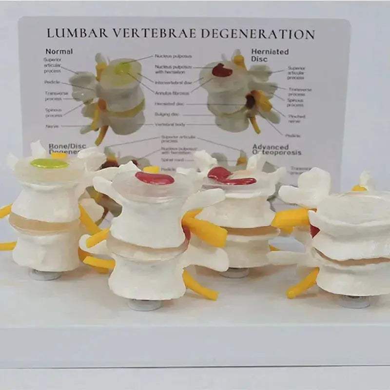 Pathological Lumbar Spine Anatomy Model For Medical Teaching - ToylandEU