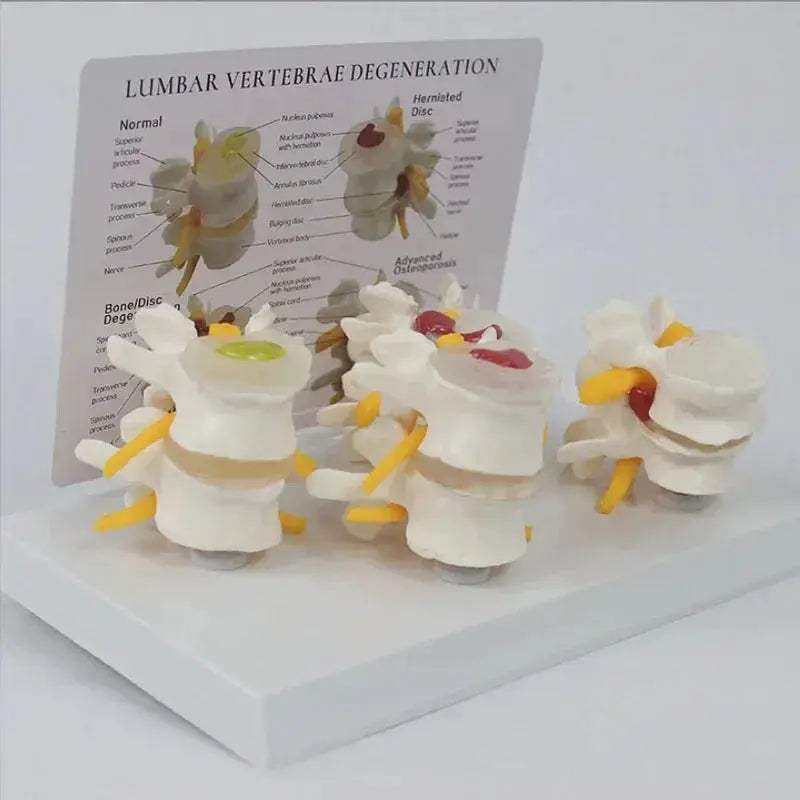 Pathological Lumbar Spine Anatomy Model For Medical Teaching - ToylandEU