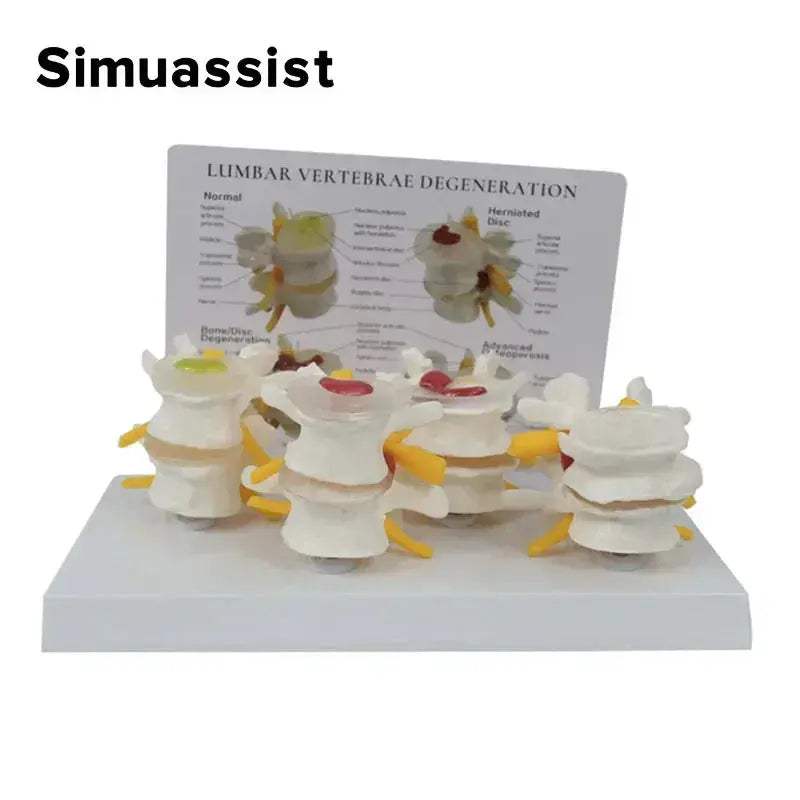 Pathological Lumbar Spine Anatomy Model For Medical Teaching - ToylandEU