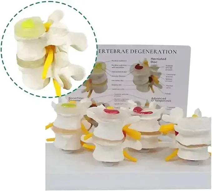 Pathological Lumbar Spine Anatomy Model For Medical Teaching - ToylandEU