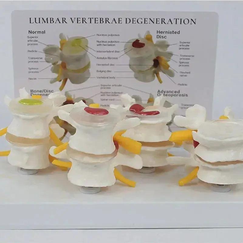  Pathological Lumbar Spine Anatomy Model For Teaching -  ToylandEU™