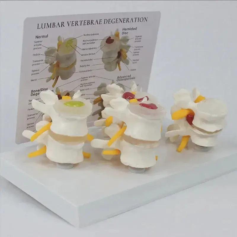  Pathological Lumbar Spine Anatomy Model For Teaching -  ToylandEU™