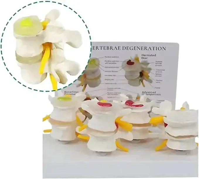  Pathological Lumbar Spine Anatomy Model For Teaching -  ToylandEU™