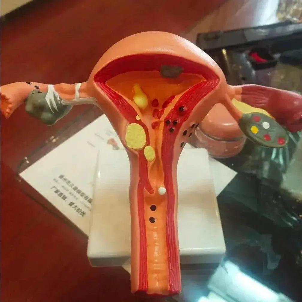  Cross Section Structure Model Human Pathological Uterus Ovary Model Uterus Anatomical Anatomy Female Organ Teaching Study Tool -  ToylandEU™